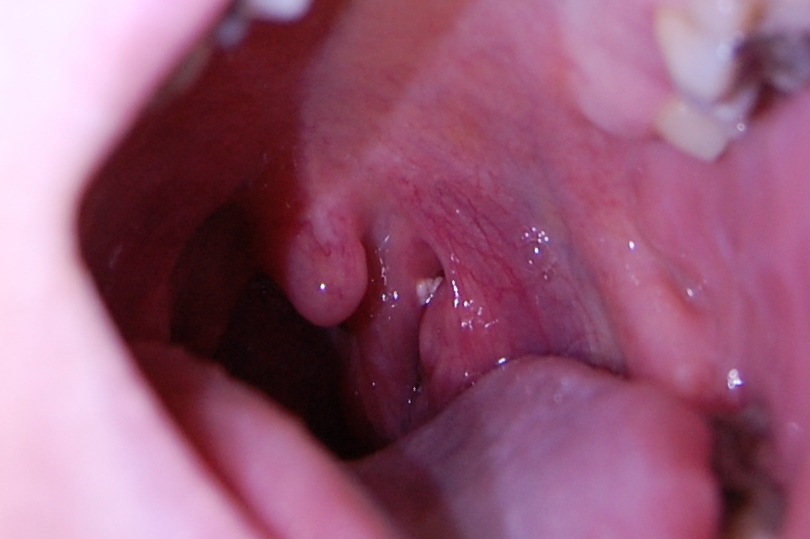 White Spot On Side Of Throat 5