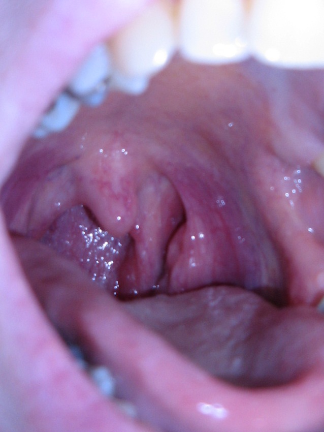 lump on tonsil - Respiratory Disorders.